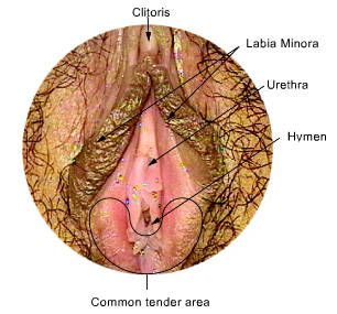 vulvodynia dubai